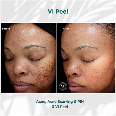 VI Peel treatment for acne scarring