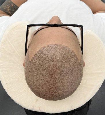 Top view of scalp Micropigmentation