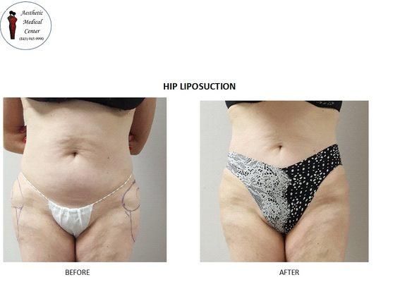 Hip Liposuction