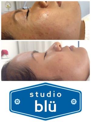 Before/After Studio Blu Acne Clinic