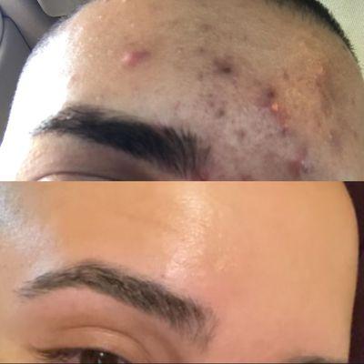 Inflammatory Acne Before/After