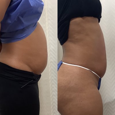 Before & After 5 treatments of Body Contouring with Accent Prime