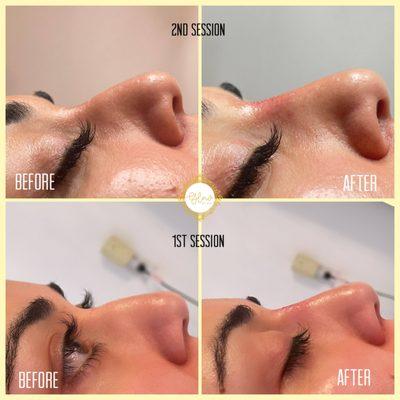 nose filler