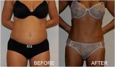 Before and after liposuction patient.  Not the dramatic improvement in the definition of the patient's abdomen.