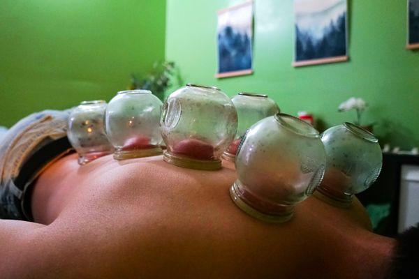 A patient getting fire cupping for his back pain