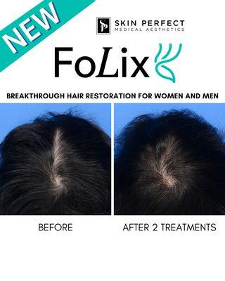 FoLix Laser for hair regrowth is effective, easy, fast, and has no downtime.