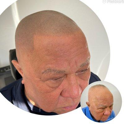 Scalp Micropigmentation