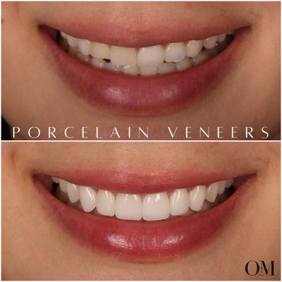 8 porcelain veneers to even out the colorations and reverse wear