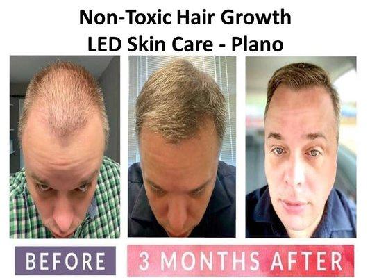 We grow hair, naturally!  No pills, shots or shampoos.  Inside out solutions for Balding, Acne and Aging.