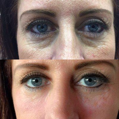 Restylane filler before and after immediately, no filter needed.