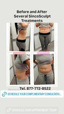 Results of several SincoSculpt and body contouring/body slimming treatments