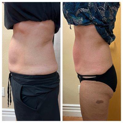 Cryo Slimming Results!! This is after 4 sessions!