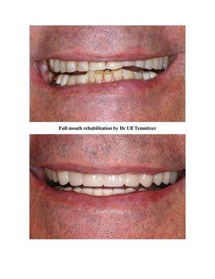 Our patient's worn teeth were beautifully restored with porcelain crowns by Dr Ulf Temnitzer.