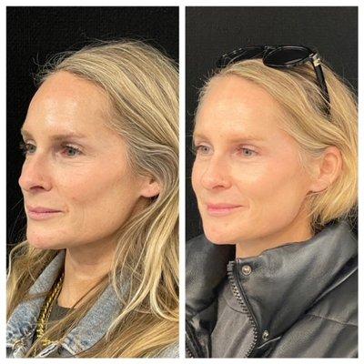 Radiesse to jawline and PRX-T33 for skin brightening.