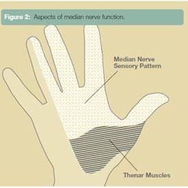 Carpal Tunnel Syndrome - Dr William Van Wyk - Dallas/Ft Worth Hand Surgeon