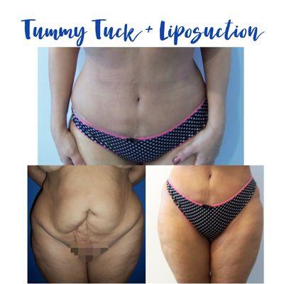 Tummy Tuck Procedure