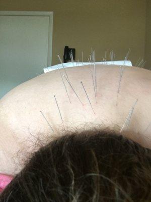 Dry needling by Dr Fishkin. 2018.