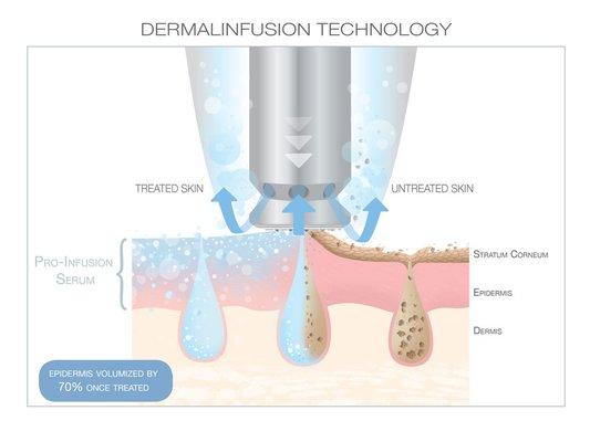 DermalInfusion is an advanced skin-resurfacing treatment that combines exfoliation, extraction, and infusion of condition-specific serums