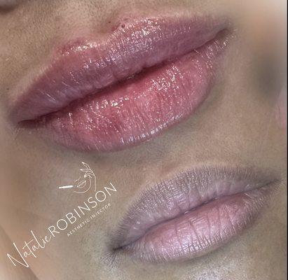 Lip Filler