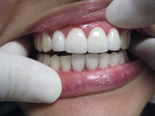 Veneers - After