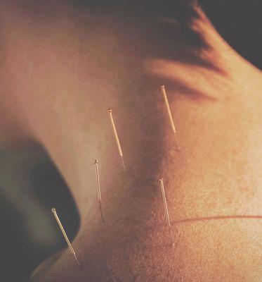 Medical Acupuncture can improve blood circulation, reduce inflammation,  & set the stage for regenerative therapies to work even better!