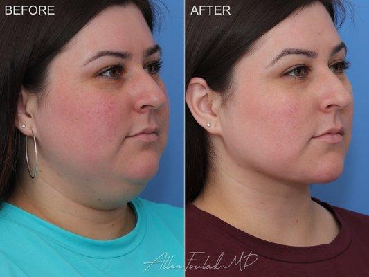 Minimal Incision Deep Sculpting (MIDS) Neck Lift, lower face micro-liposuction, and buccal fat reduction.