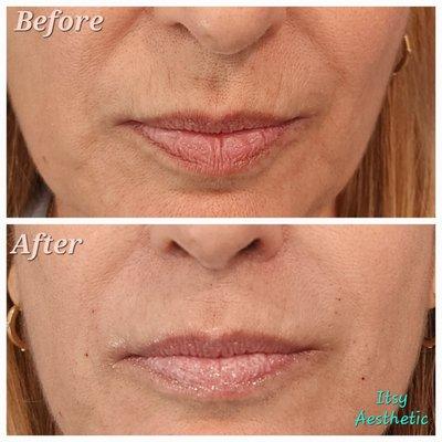 Filler and Thread of nasolabial folds berore/after picures