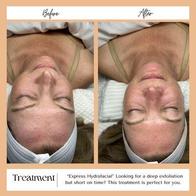 Look how even the express Hydrafacial transformed her skin. She needed a deep exfoliation. Her pores were cleaned and skin left glowing!