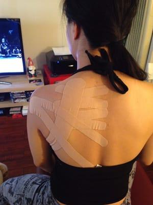 One a patient (a dancer) getting a kinesio tape treatment for shoulder and back injury