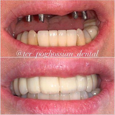 Full arch zirconia implant restoration!!!