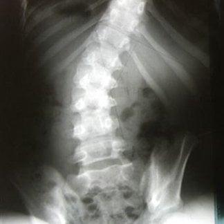 scoliosis. noun. lateral curvature of the spine.