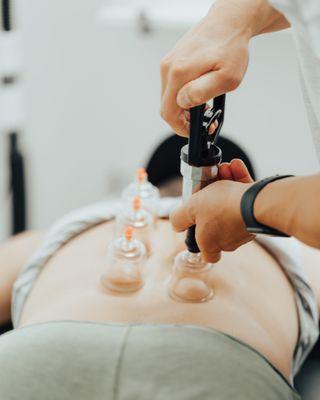 Cupping therapy for back pain