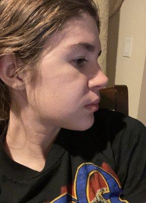 Profile at 2 weeks post op , shows how fast my swelling went down which I rlly believe is due to the surgeon's skill