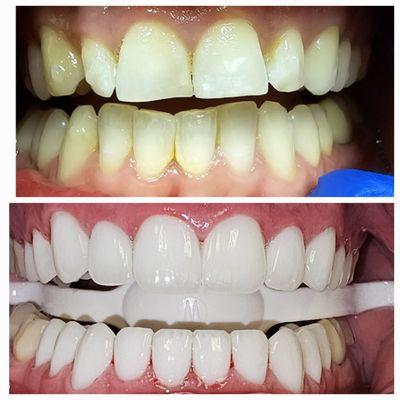 VENEER SMILE MAKEOVER!