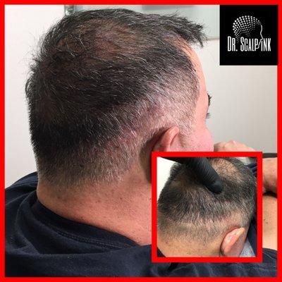 Hair transplant coverage for scarring and density added to thin hair following hair transplant procedure