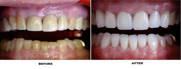 Full Mouth Cosmetic Rehabilitation