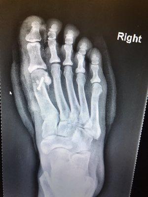 Surgical correction of bunions