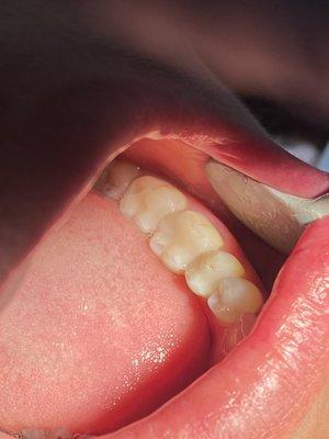 After onlays, patient left with natural looking teeth.