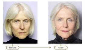 You can regrow your own collagen with Sculptra, regardless of your age! An all over facial treatment which can also be used in the hands!