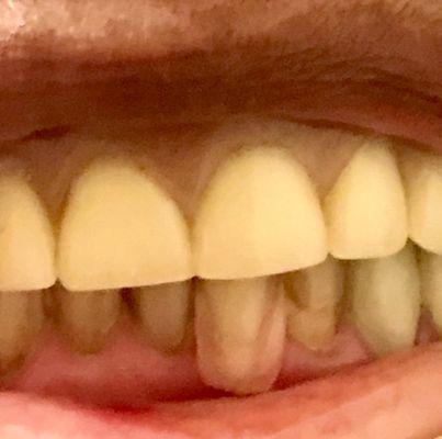 Horrible/Painful dental work by Dr. Lorraine Clark and staff at Dental Care on Yellow Bluff costing $2K! AVOID! I want refund