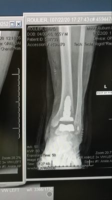 Ankle replacement