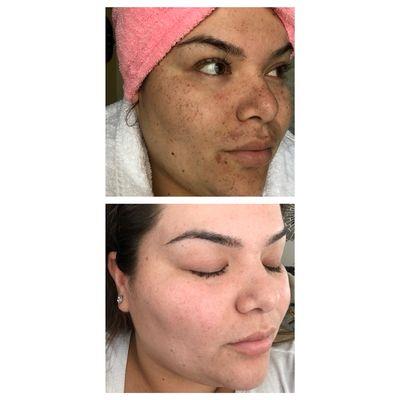 (Actual client) Photofacial IPL