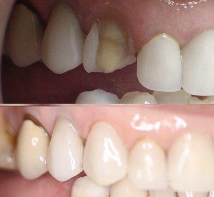 Patient came in tour office with a broken veneer. Dr. Phen restore the tooth & our patient left happy.