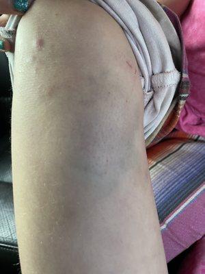 Bruise