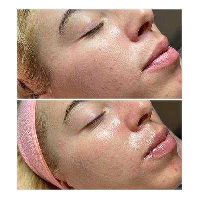 Pro facial 5 - N - 1 with brightening mask