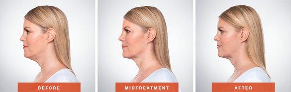 Kybella - injectable fat dissolver for under the chin fat