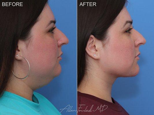 Minimal Incision Deep Sculpting (MIDS) Neck Lift, lower face micro-liposuction, and buccal fat reduction.