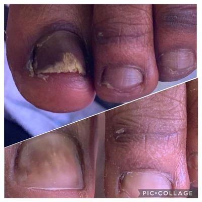 Mens waterless pedicure w/toenail restoration