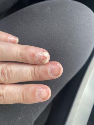 Nail damage after acrylic removal