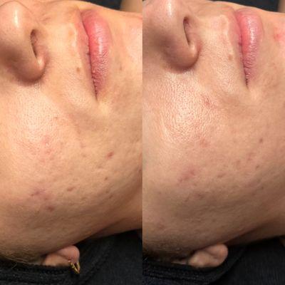 Before and after her second acne scarring treatment